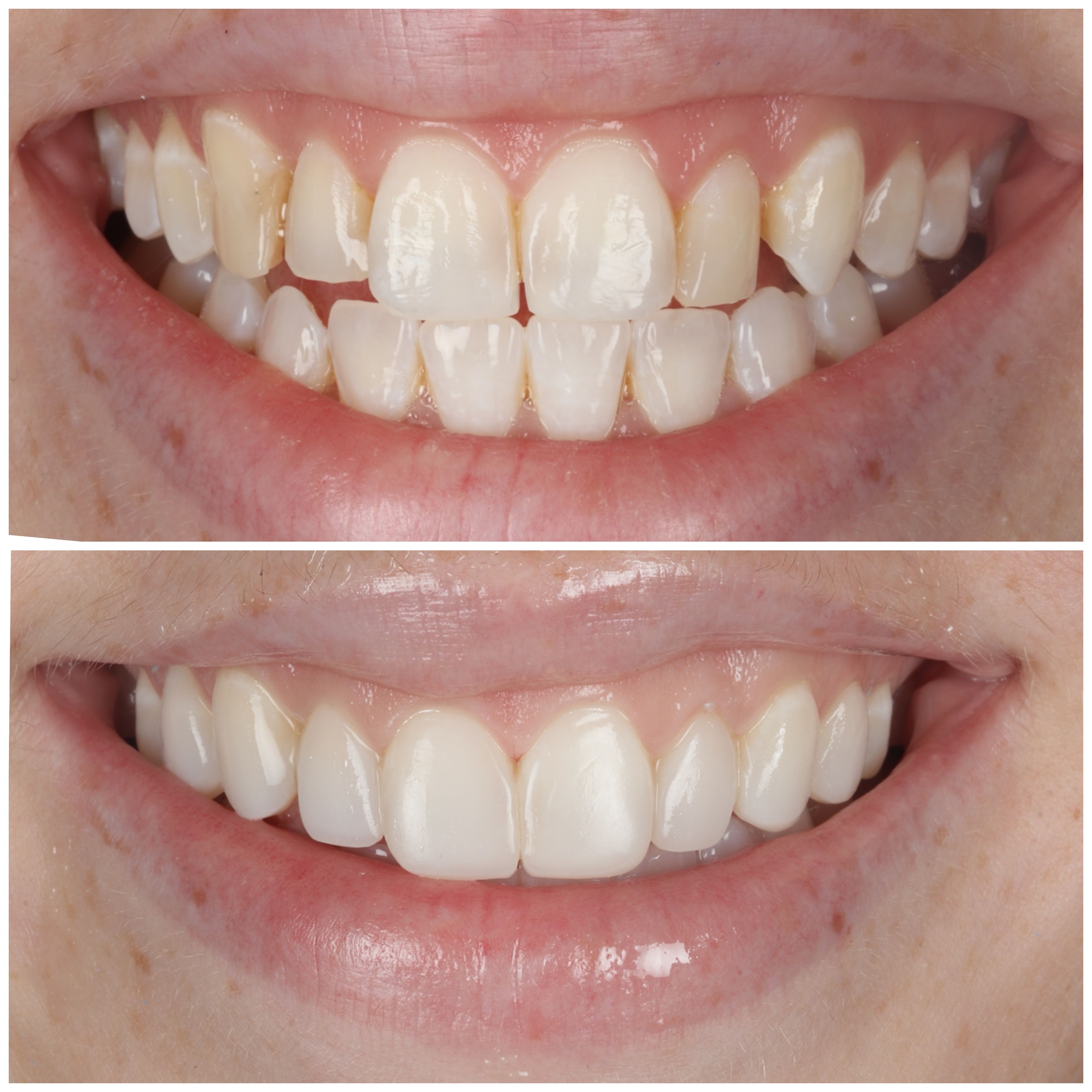 Clear Aligners Package